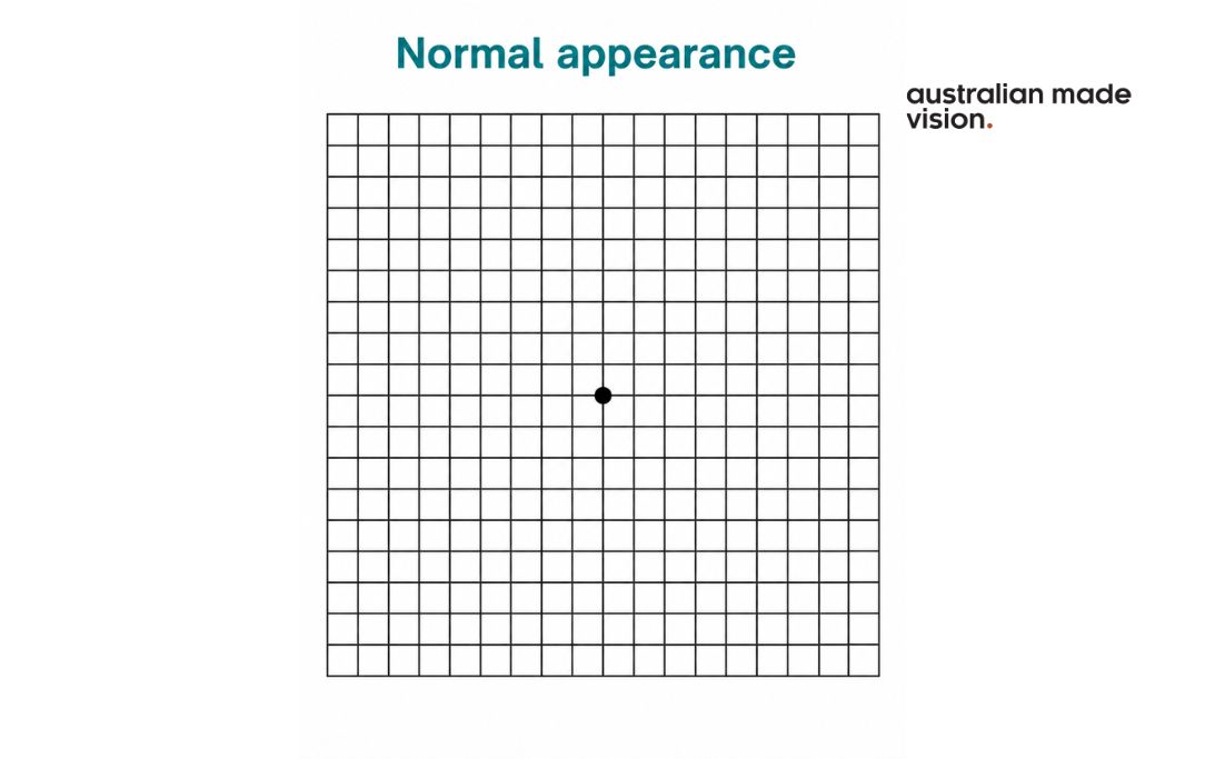 Amsler grid with straight, evenly spaced lines and a clear central dot showing a normal appearance