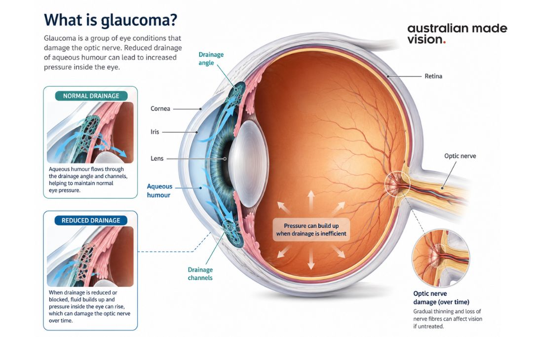 Diagram showing how reduced aqueous humour drainage may increase eye pressure and contribute to optic nerve damage in glaucoma