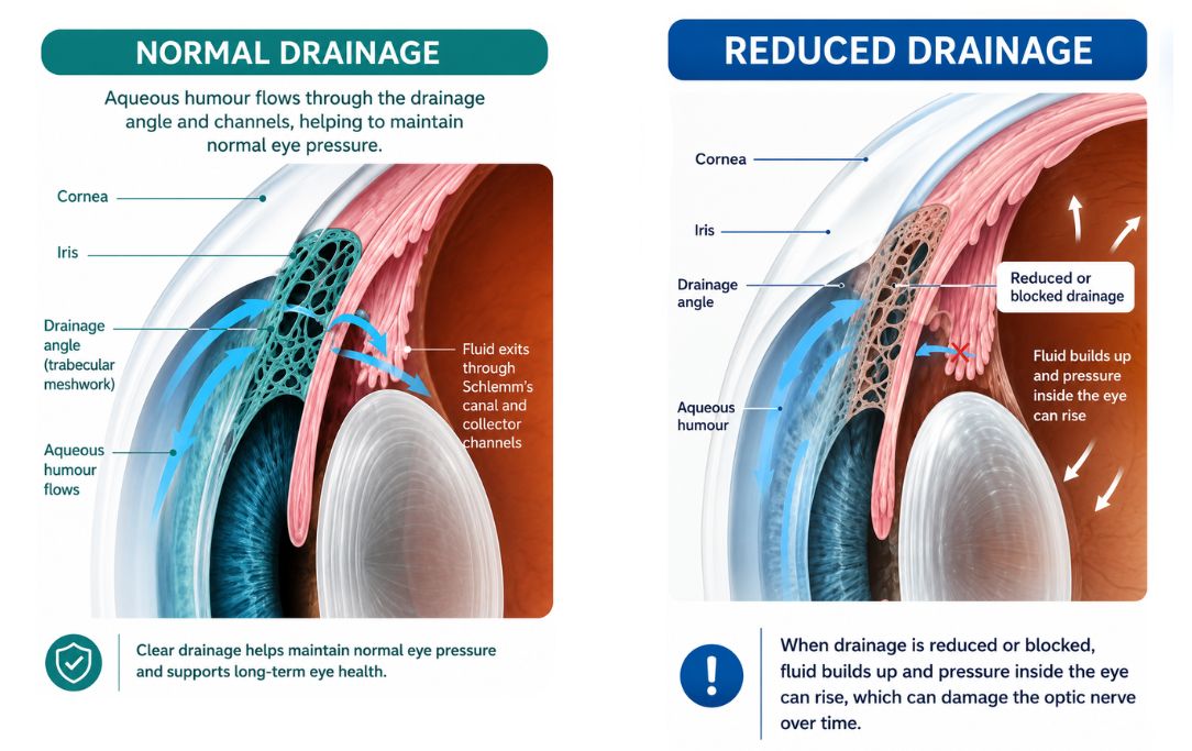 Diagram comparing normal and reduced aqueous humour drainage, showing how fluid build-up may increase eye pressure in glaucoma
