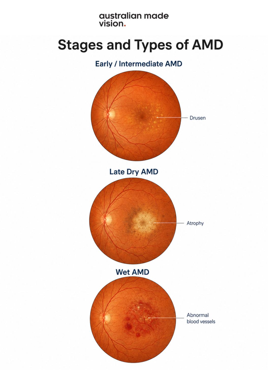 Diagram comparing early and intermediate AMD with drusen, late dry AMD with geographic atrophy, and wet AMD with abnormal blood vessels